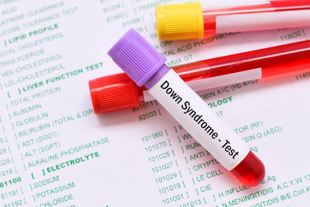 La ricerca scientifica italiana sulla sindrome di Down fa grandi passi in avanti